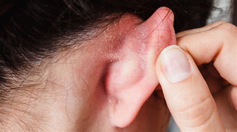 What Causes Dry Skin Buildup In Ears